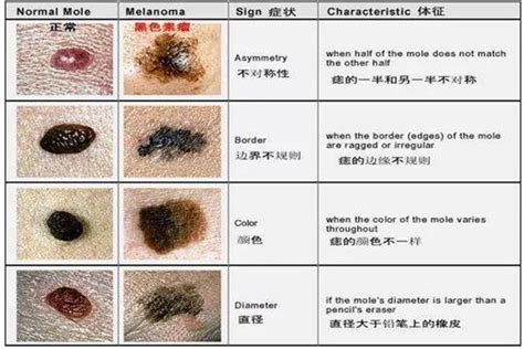 痣 vs 墨|【痣 vs 墨】痣 vs 墨：搞清楚皮膚斑點大不同，如何安全去癦不留。